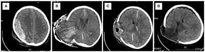 Secondary hyperperfusion injury following surgical evacuation for acute isolated epidural hematoma with concurrent cerebral herniation